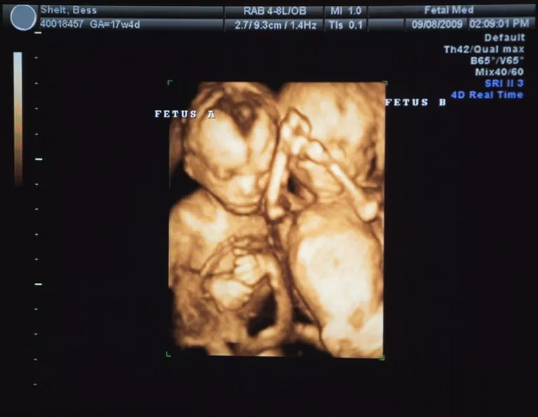 17 haftada ultrasonda ikiz gebelik